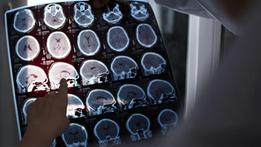 La malattia di Alzheimer provoca un progressivo decadimento delle funzioni cognitive